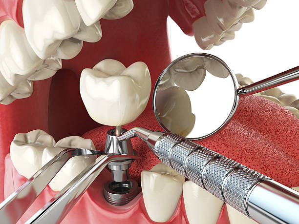 Best Knocked-Out Tooth (Avulsed Tooth) Treatment in Nesconset, NY