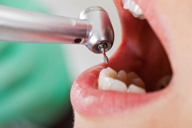 Best Emergency Wisdom Tooth Extraction in Nesconset, NY